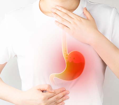 Symptome der Refluxkrankheit entstehen durch wiederholtes Aufsteigen von Magensäure in die Speiseröhre.